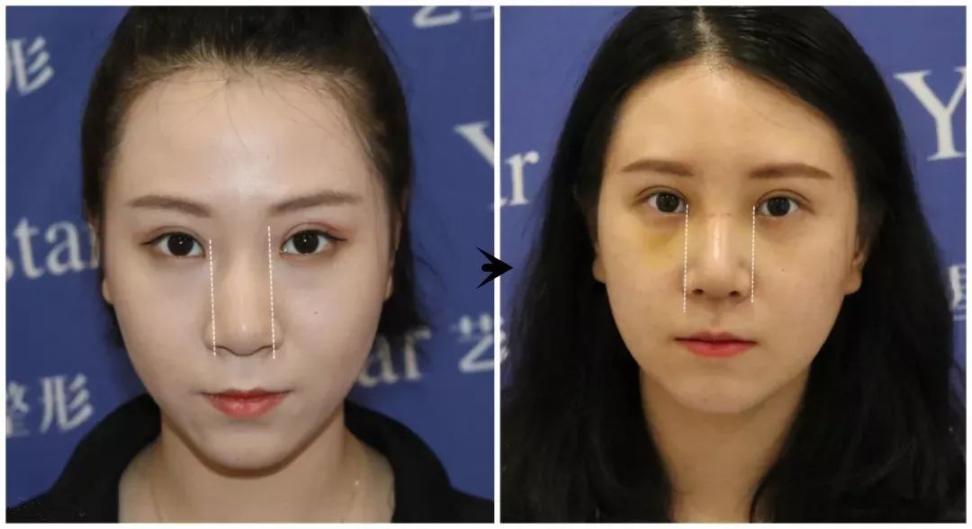 济南艺星隆鼻:鼻翼大,只做鼻翼缩小可以吗?