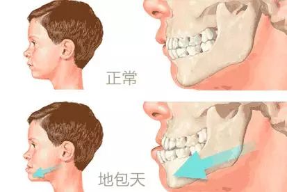 2,兜齿(地包天)