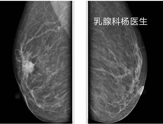 济南乳腺病医院:乳腺彩超,钼靶检查怎么选?越贵的检查