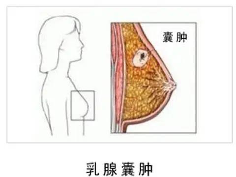 乳腺囊肿 乳腺囊肿严格意义上不能算是乳房疾病.