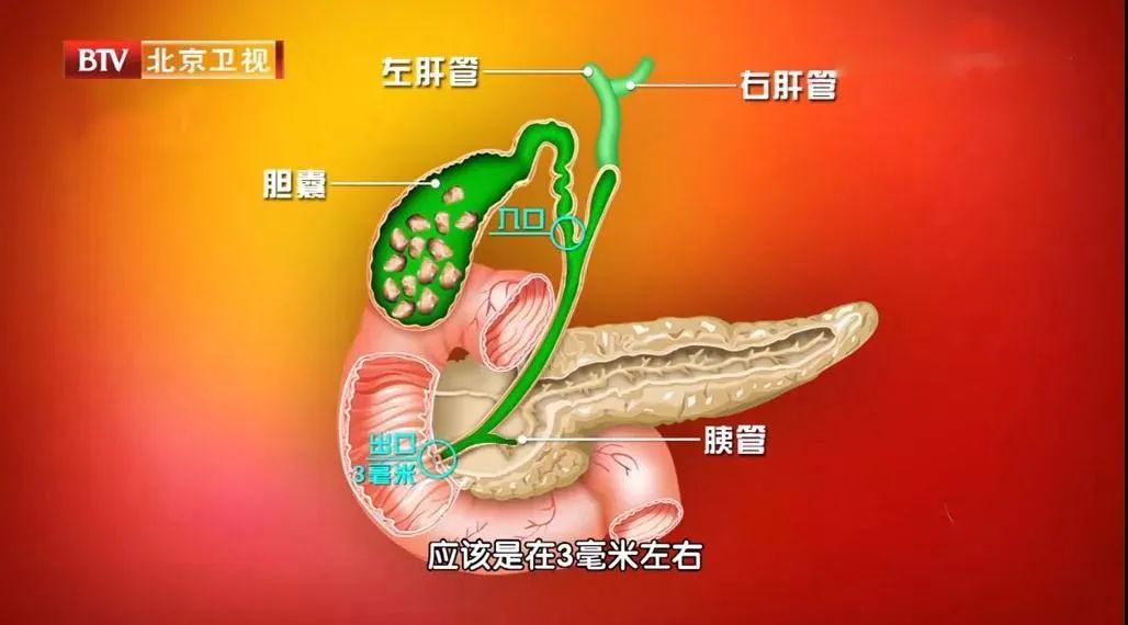 发热等症,少数可出现黄疸;b超检查发现胆囊肿大,胆囊壁增厚,有胆结石