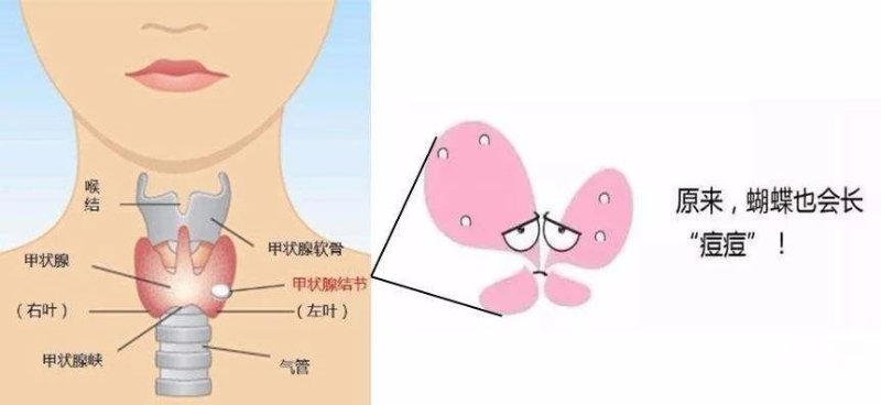 "需要提醒的是,并不是所有的甲状腺结节都能用手摸到.