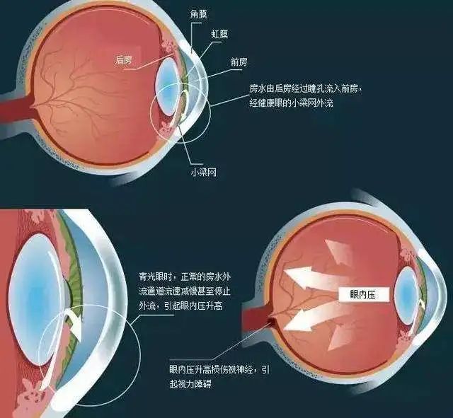 眼球中前房中水循环的动态平衡被破坏,房水增多导致