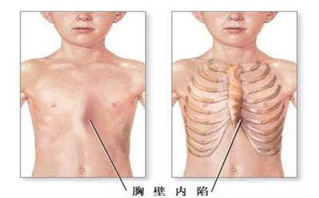 开创了胸外悬吊新生儿漏斗胸矫治和改良nuss手术治疗儿童漏斗胸,在