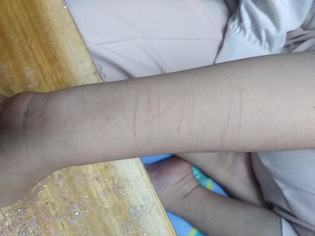 邓女士称女儿手腕上的伤痕是被邝某等人殴打留下的