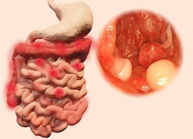 肠息肉是消化系统非常常见的疾病,一般好发于结肠和直肠,这种息肉一般