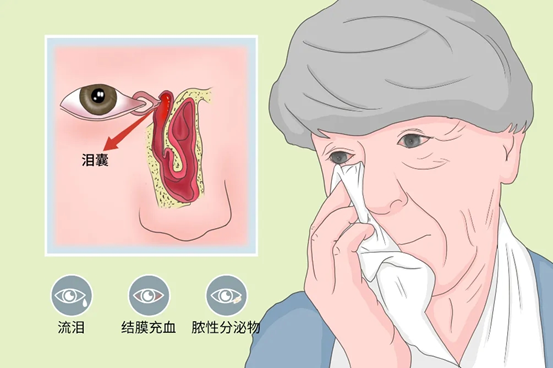 泪小管,泪囊与鼻泪管交界处以及鼻泪管下口,以溢泪为主要症状的疾病