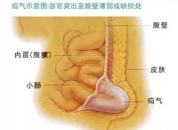 来者不"疝",女性朋友别大意!