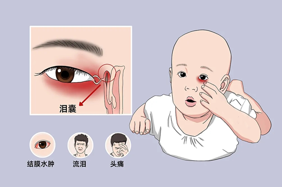 急性泪囊炎由于鼻泪管阻塞,细菌和泪液积聚在被阻塞的泪囊内,并经常