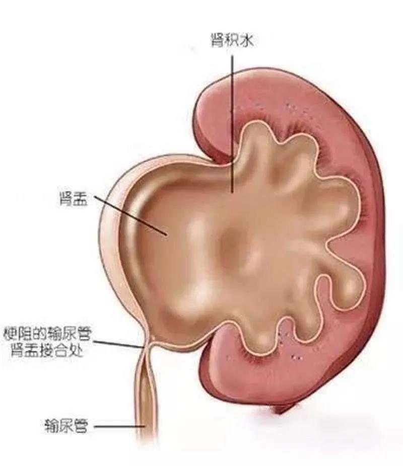 长,也未在意,今又左腰疼痛不适,在当地医院行b超检查示:左肾重度积水