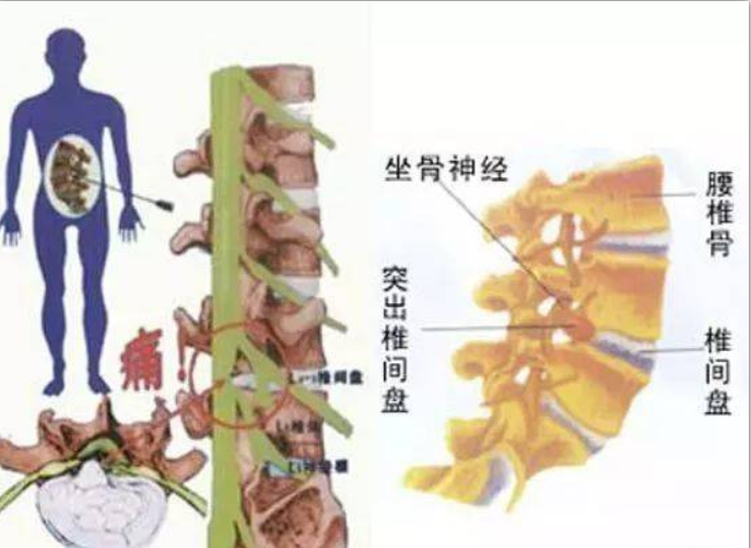 找到治疗腰椎间盘突出的正确方法其实很简单!