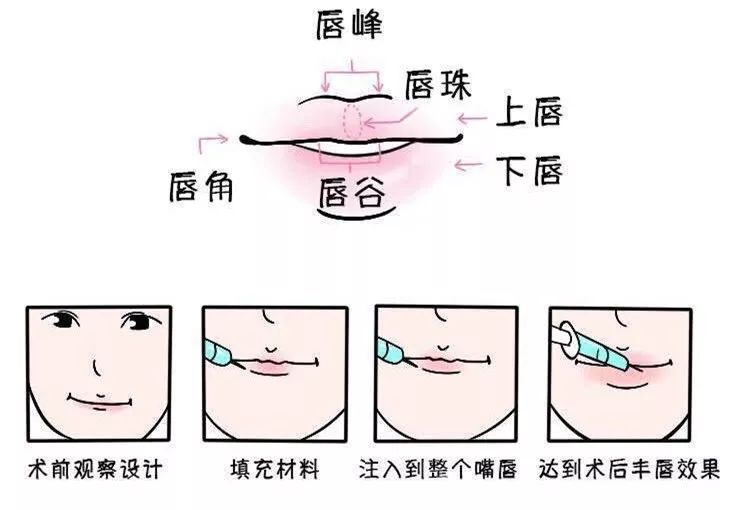 注射嘟嘟唇注射几个点图片