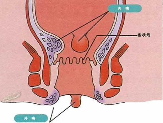 直肠肛管的位置在人体腹腔的最下部,蹲厕过久,在重力和腹腔脏器作用的