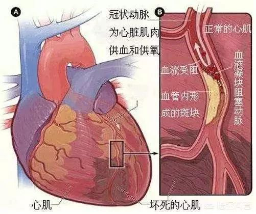 老人二次心梗引发心衰日照心脏病医院拦停死亡多米诺骨牌