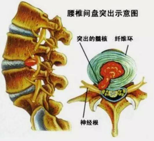 腰突坐骨神經痛足足折磨我3年,榆錢 白酒,沒手術趕走了腰腿疼