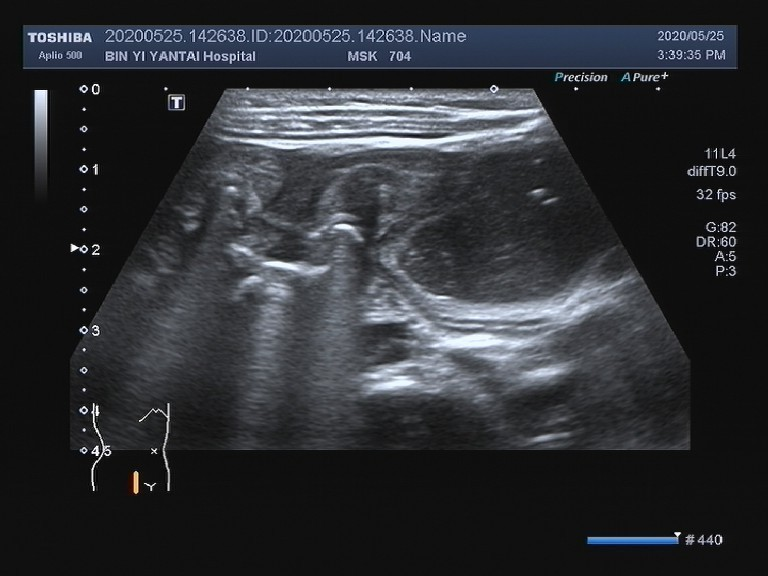 经过反复认真扫查,最终在患儿右下腹发现了梗阻点并怀疑肠腔内存在