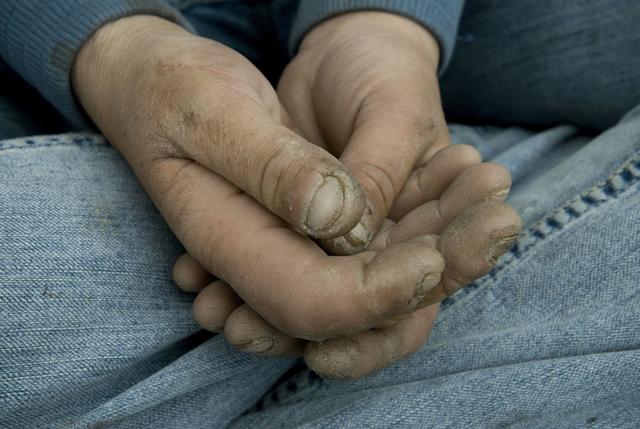 工伤导致男子拇指被斩断,3d全形手指再造术将手指复原!