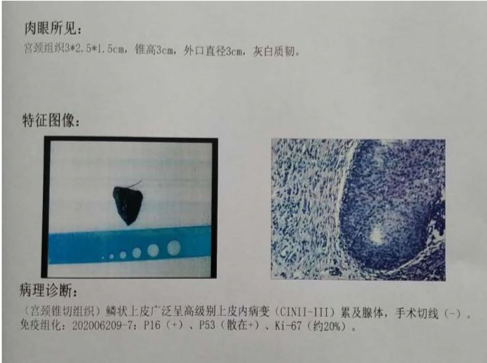 41岁女子5年没做妇科检查妇女两癌筛查出宫颈癌前病变