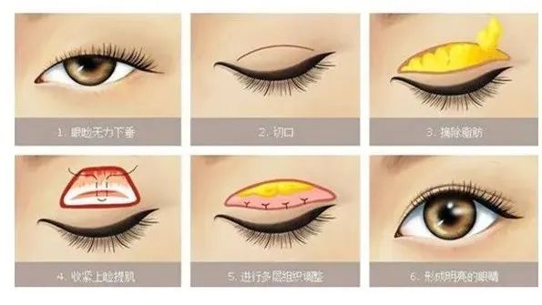 去割双眼皮,为啥总让你做"上睑提肌"?