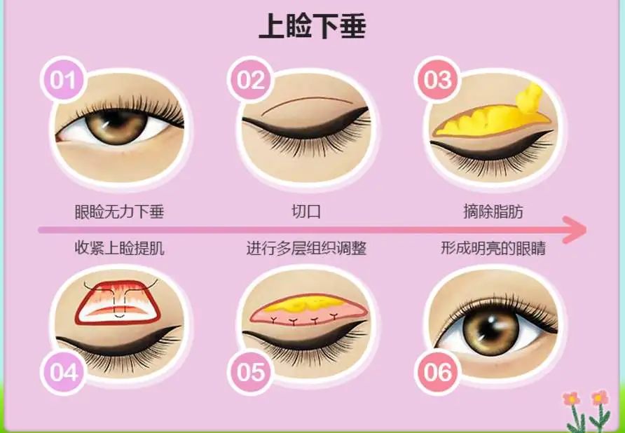 去割双眼皮,为啥总让你做"上睑提肌"?