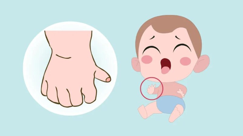 【干货】孩子多长了个手指怎么办?多指症如何治疗?