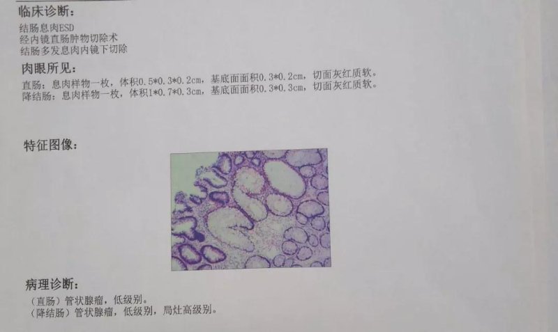 结肠癌检查报告图图片
