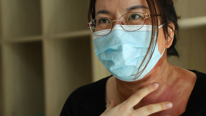 果然视频｜女子拔罐被二度烧伤，涉事美容馆拒赔：狮子大开口