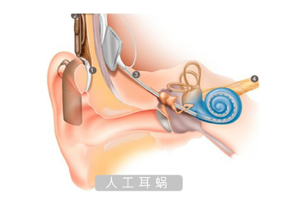 你所關心的人工耳蝸那些事,聽聽專家怎麼說