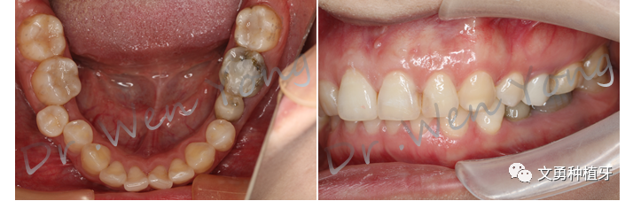 愈合机台怎么识别型号种植牙需要反复就诊大半年？这种种植牙技术只需两次就诊即可完成_https://www.jmylbn.com_新闻资讯_第2张