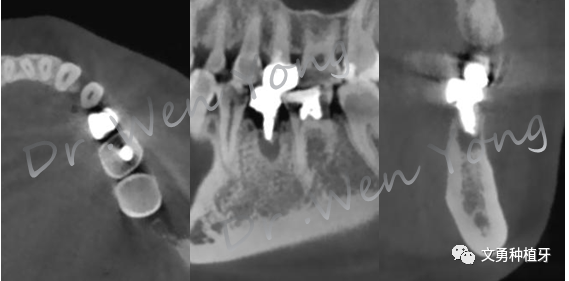 愈合机台怎么识别型号种植牙需要反复就诊大半年？这种种植牙技术只需两次就诊即可完成_https://www.jmylbn.com_新闻资讯_第3张