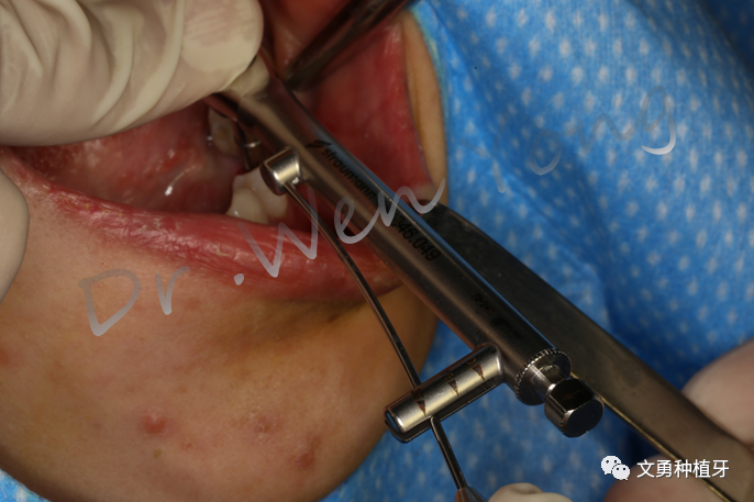 愈合机台怎么识别型号种植牙需要反复就诊大半年？这种种植牙技术只需两次就诊即可完成_https://www.jmylbn.com_新闻资讯_第6张