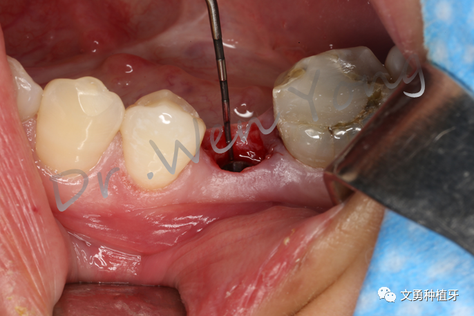 愈合机台怎么识别型号种植牙需要反复就诊大半年？这种种植牙技术只需两次就诊即可完成_https://www.jmylbn.com_新闻资讯_第7张