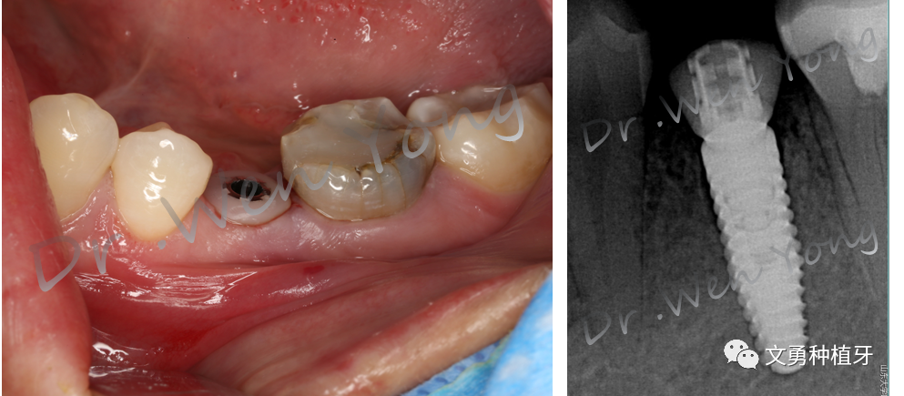 愈合机台怎么识别型号种植牙需要反复就诊大半年？这种种植牙技术只需两次就诊即可完成_https://www.jmylbn.com_新闻资讯_第11张
