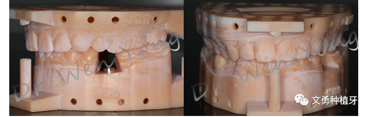 愈合机台怎么识别型号种植牙需要反复就诊大半年？这种种植牙技术只需两次就诊即可完成_https://www.jmylbn.com_新闻资讯_第12张