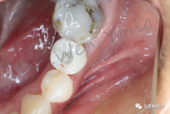 愈合机台怎么识别型号种植牙需要反复就诊大半年？这种种植牙技术只需两次就诊即可完成_https://www.jmylbn.com_新闻资讯_第14张
