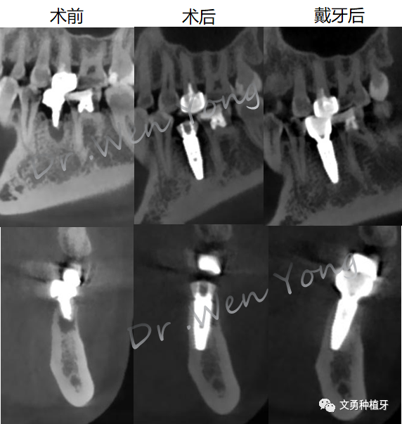 愈合机台怎么识别型号种植牙需要反复就诊大半年？这种种植牙技术只需两次就诊即可完成_https://www.jmylbn.com_新闻资讯_第16张