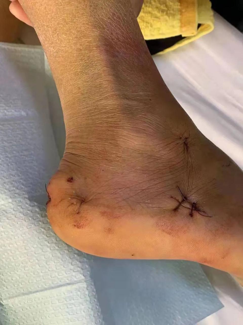 俗话说,伤筋动骨一百天.传统的骨折手术,伤者通常需要待14天.