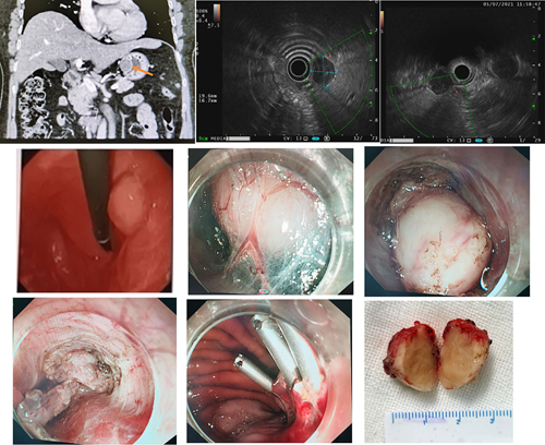 做胃镜发现胃粘膜下鼓起"小球"?需警惕胃间质瘤-齐鲁晚报网