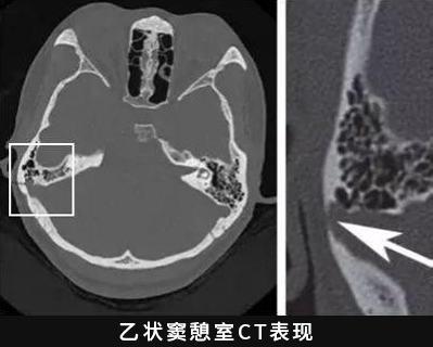 乙状窦骨壁图片