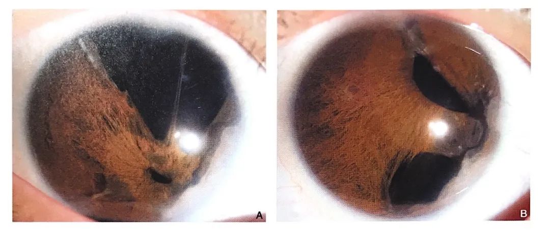 先天虹膜形态异常先天性白内障单眼上睑下垂新生儿泪囊炎(先天鼻泪管