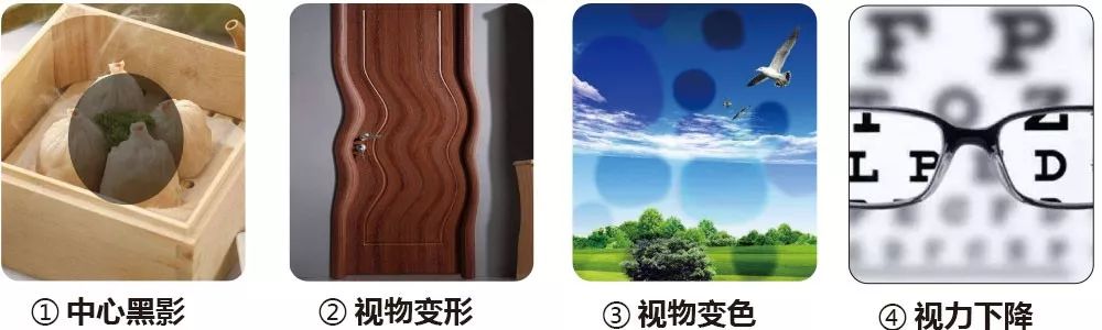 的视力非常低,一旦黄斑受损,会出现中心视力急剧下降,视物变形等症状