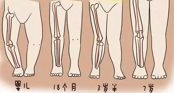 孩子腿弯,家长给绑腿?医生:不能一概而论