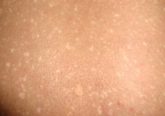 汗斑,是花斑癣的俗称,中医文献中称为"紫白癜风",多由风湿之邪侵入