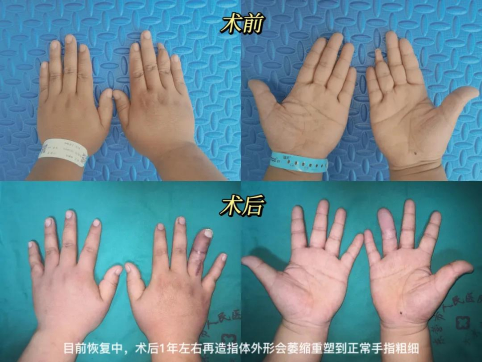 脚趾变手指东营市人民医院成功完成东营地区首例手指全形再造术