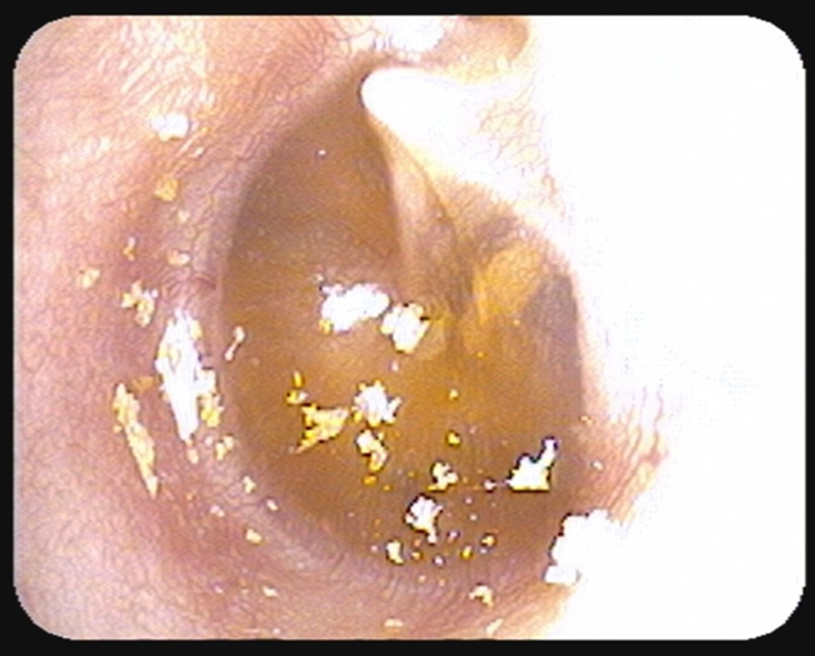 啊我没听清孩子分泌性中耳炎别错过早期预警