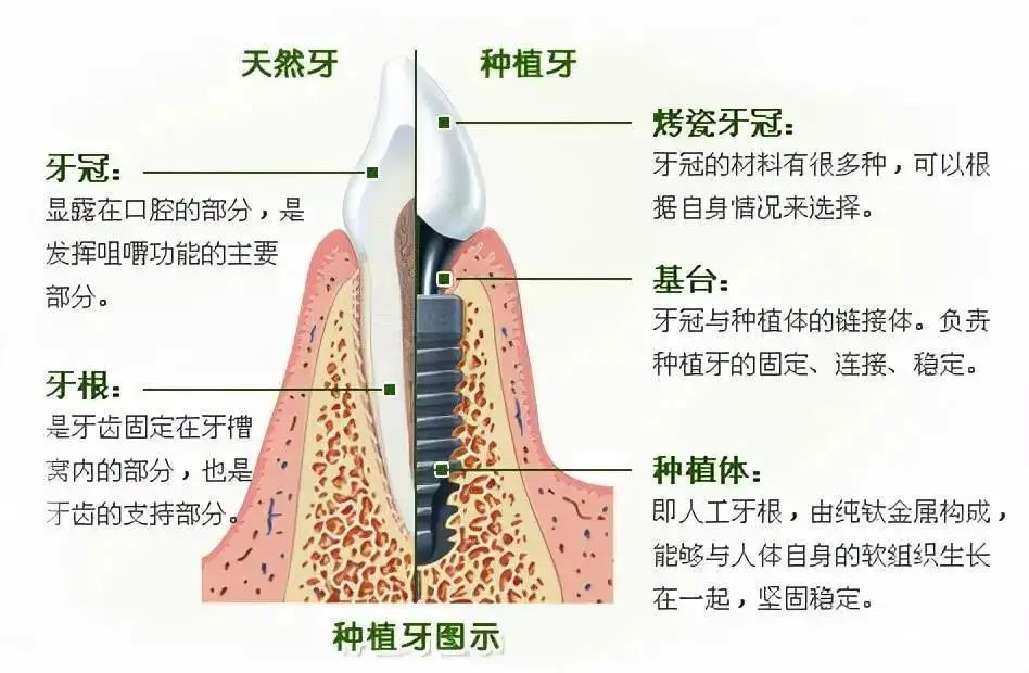 种植牙齿(dental implant)指的是一种以植入骨组织内的下部结构为基础