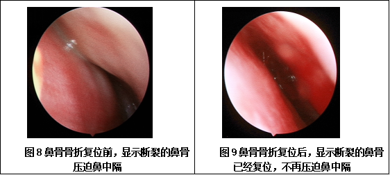 鼻骨骨折手术图片