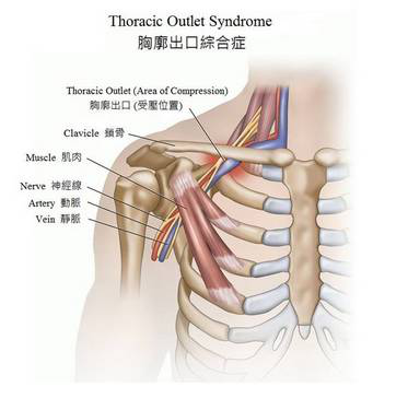 手麻不一定是颈椎病,警惕"胸廓出口综合征"!-齐鲁晚报·齐鲁壹点