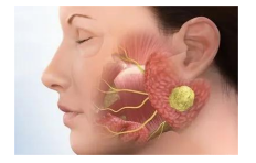 4. 颌面部感染:智齿冠周炎,面部间隙感染,腮腺炎,颌骨骨髓炎等.