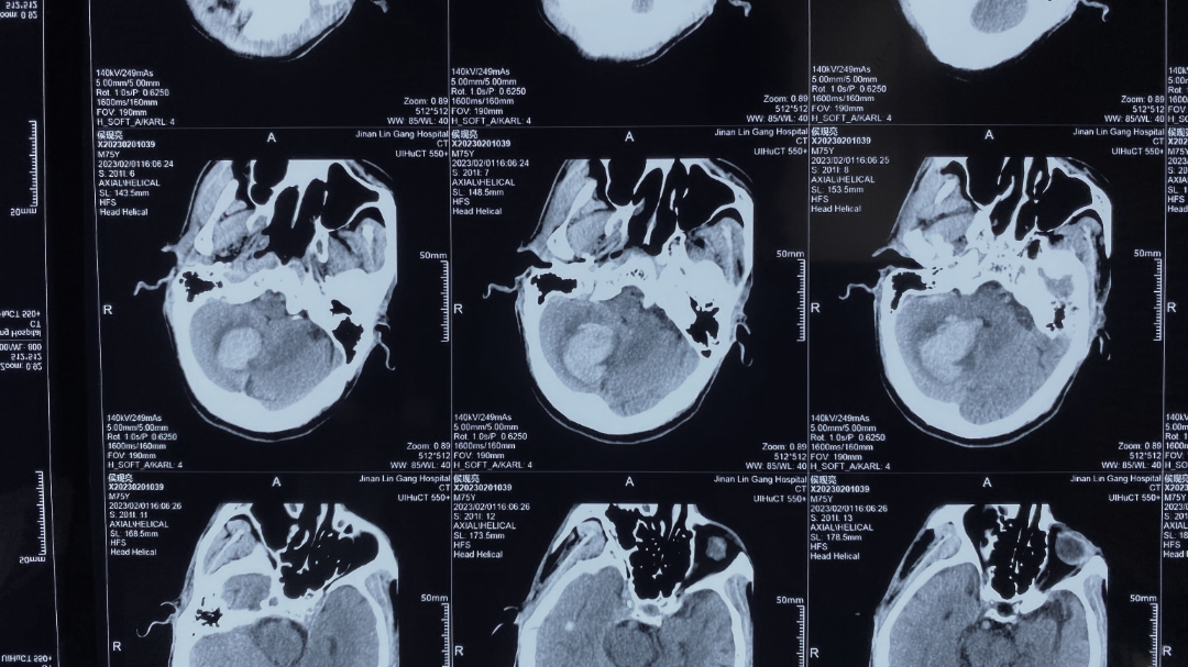 入院后立即行ct检查发现小脑出血;由于病情重情况复杂
